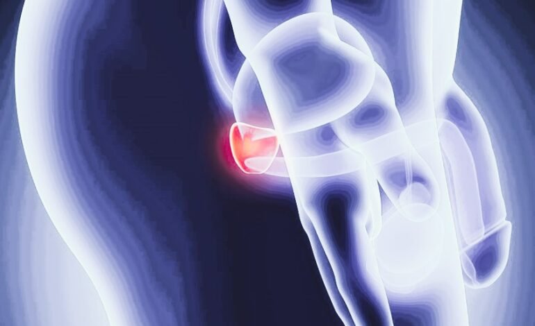 Estudio revela que un estilo de vida saludable mejora la supervivencia en hombres con cáncer de próstata