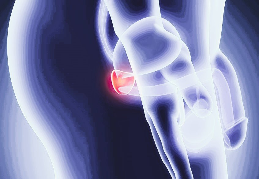 Estudio revela que un estilo de vida saludable mejora la supervivencia en hombres con cáncer de próstata