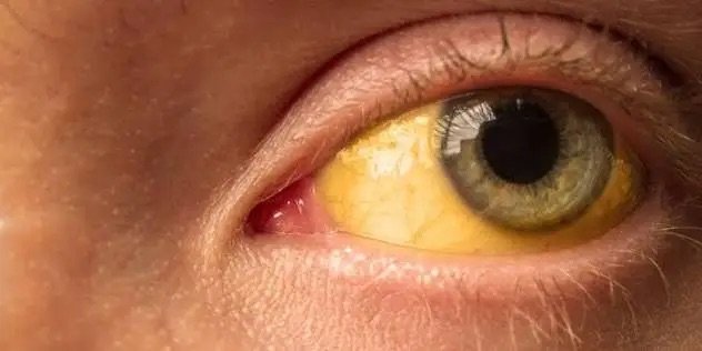 Hepatitis viral causaría más muertes que malaria, tuberculosis y sida combinados para 2040